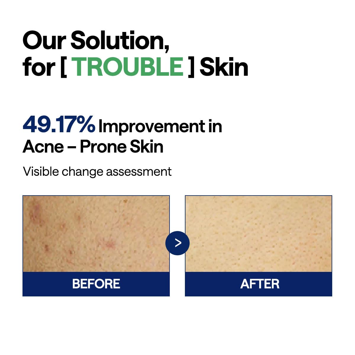 Mediheal Teatree Trouble Toner Pad – Calming & Soothing Vegan Gauze Pads for Acne-Prone Skin | Wholesale K-Beauty