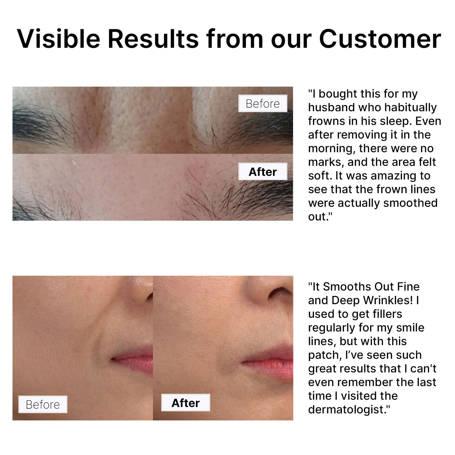 Before and after photos showing wrinkle improvement with Hue Calm patches – visible results on frown and smile lines