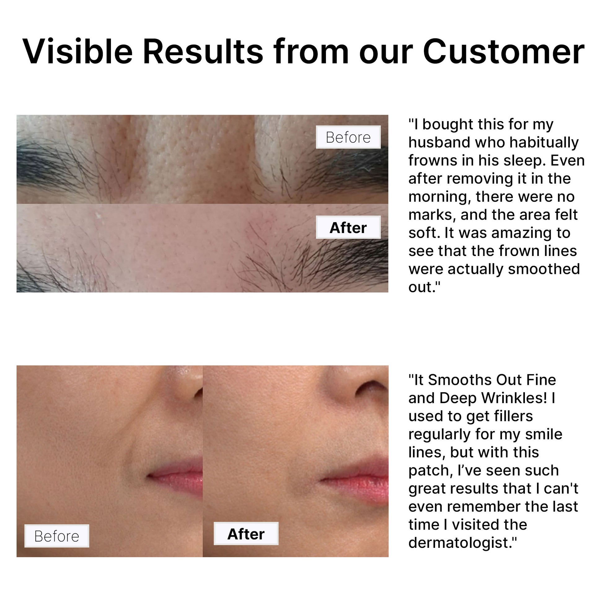 Before and after photos showing wrinkle improvement with Hue Calm patches – visible results on frown and smile lines