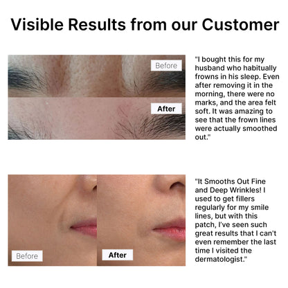 Before and after photos showing wrinkle improvement with Hue Calm patches – visible results on frown and smile lines