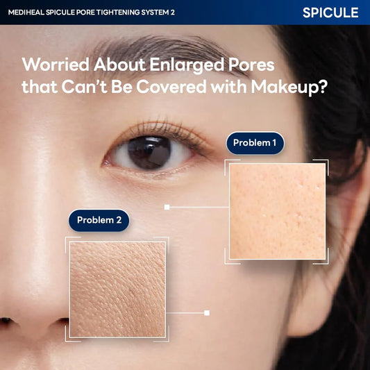 Comparison of enlarged pores before and after using Mediheal Spicule Pore Tightening System 1